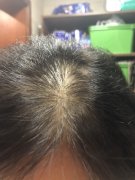 不用植发也能解决形象问题