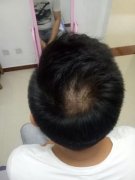 没想到头发说脱就脱