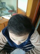 头发稀疏导致我的自信不足