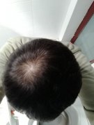 脱发带来的负能量太多了