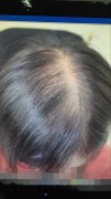 重新找回被毁掉的脱发