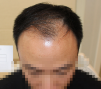头发脱落的厉害怎么办
