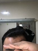 头上的头发掉的太多怎么办