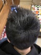 头发每天脱落的太多怎么办