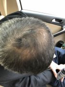 搞清脱发的原因