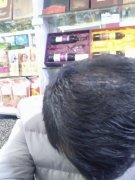 脱发的烦恼太多了