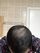 脱发让我彻底的绝望