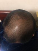 我也加入了脱发的行列