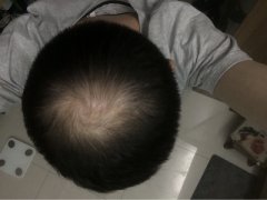 爱打游戏的脱发宅男