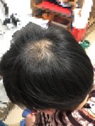 头发掉的让我抓狂