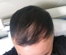 头发脱落的原因到底是什么