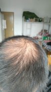掉头发是正常的吗