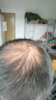 掉头发是正常的吗