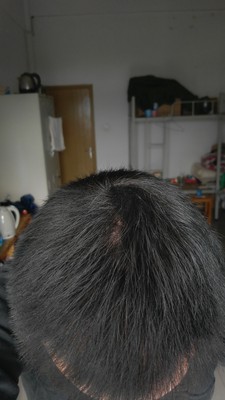 掉头发是正常的吗