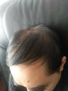 不想再因为脱发被人坑