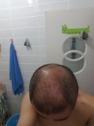 怎么才能摆脱脱发的困扰