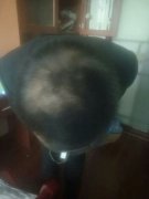 为什么我的头发会掉的那么多