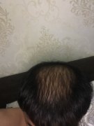 头发脱落让我的形象一落千丈