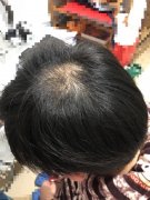遗传原因导致的脱发