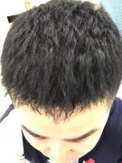 脱发让我简直崩溃