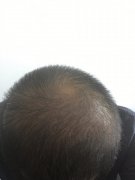 解决头发稀疏的方法