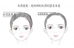 额头植发效果如何