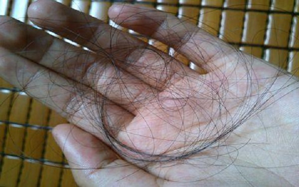 雄性脱发能自愈吗