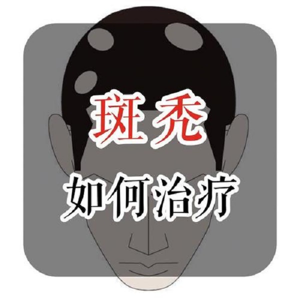 斑秃植发效果好吗