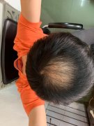 脱发的烦恼谁能懂