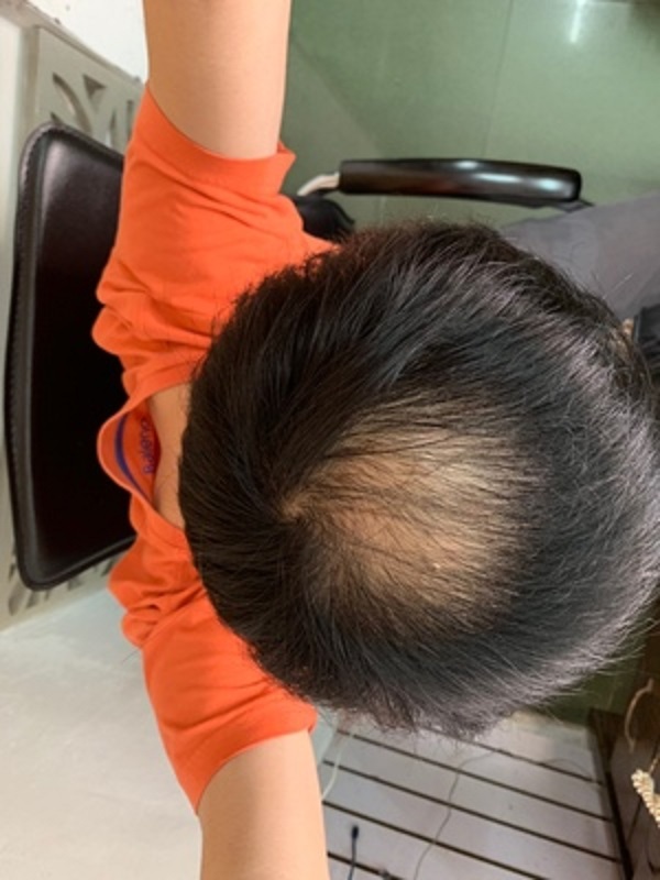 脱发的烦恼谁能懂