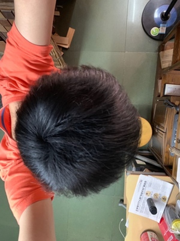 脱发的烦恼谁能懂