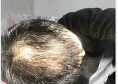 什么方法能解决脱发的问题