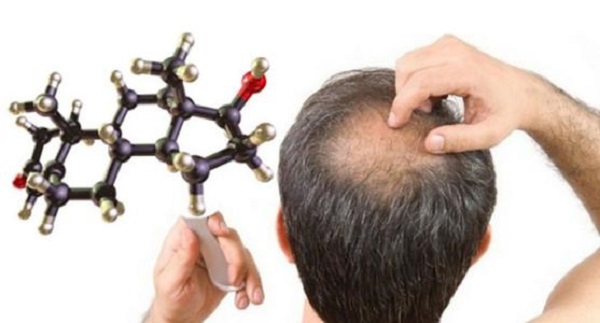 雄性激素脱发怎么确认