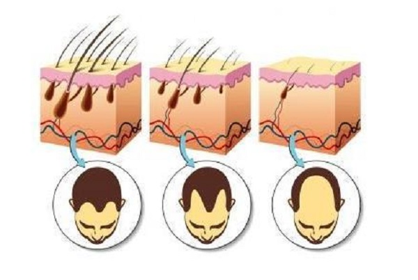 怎么缓解遗传性脱发