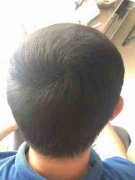 脱发影响我的生活太深了