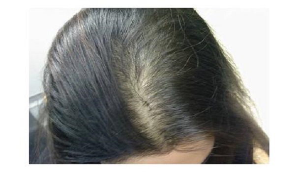 女性植发有后遗症吗