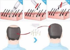毛囊坏死植发有用吗