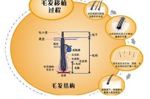 植发技术成熟吗