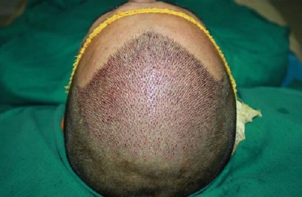 植发手术失败的修复方法