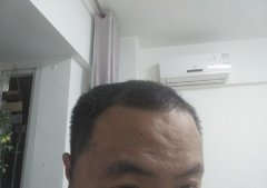 什么药物治疗脱发最有效