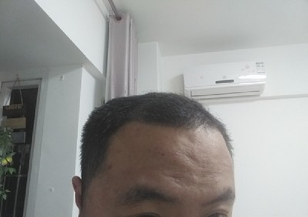 什么药物治疗脱发最有效