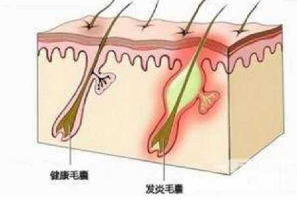 植发后出现毛囊炎怎么办