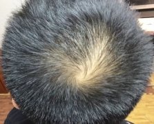 风华正茂的年纪却脱发了