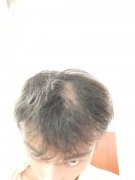 苏玫氏头发纤维粉终结了我的烦恼