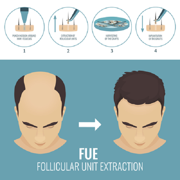 FUT和FUE到底哪个植发技术好