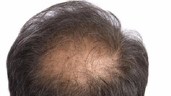 遗传性脱发植发后还会脱发吗