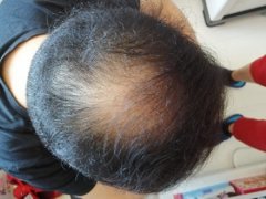 拯救头发的漫长之旅