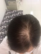 怎么才能解决脱发所造成的问题