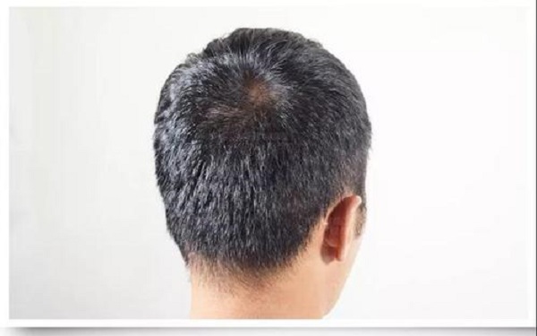 植发手术会不会有后遗症