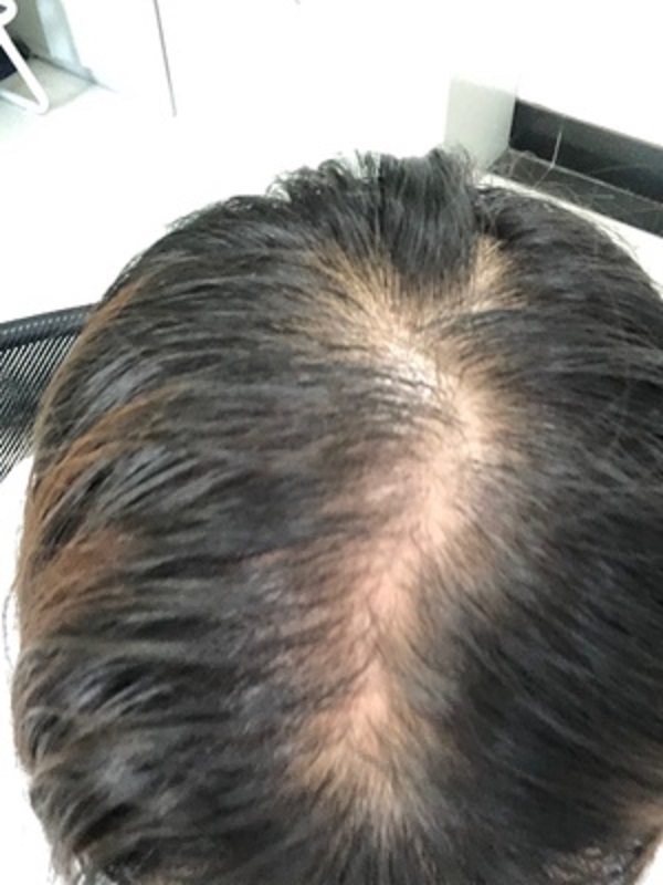 乐观派也架不住脱发的悲哀